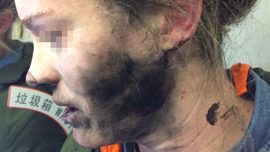 Беспроводные наушники взорвались прямо на голове у женщины фото