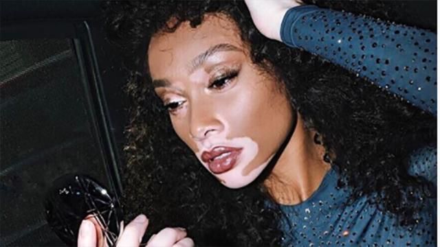 Відома модель з вітіліго показала фігуру у прозорому комбінезоні: фото Відома модель з вітіліго показала фігуру у прозорому комбінезоні: фото