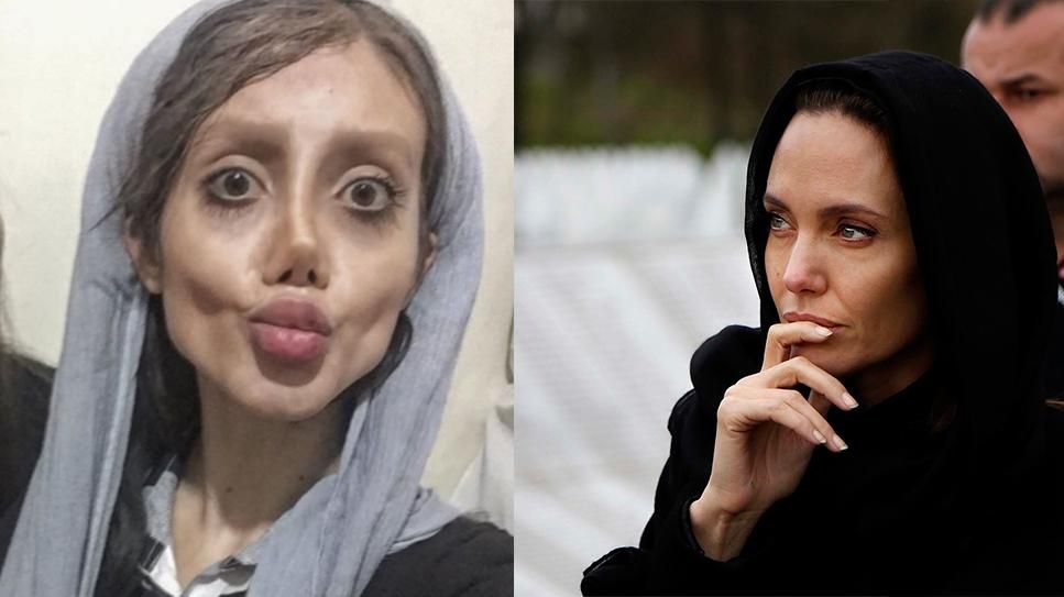 Дівчина зробила 50 операцій, щоб бути схожою на Анджеліну Джолі: шокуючий результат 