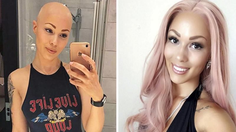 Дівчина, яка втратила волосся, подолала комплекси і стала зіркою мережі: фото 