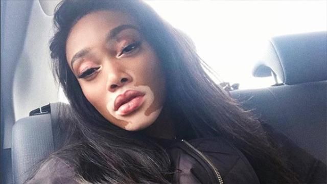 Модель з вітиліго похизувалася стрункою фігурою на пляжі: фото Модель з вітиліго похизувалася стрункою фігурою на пляжі: фото