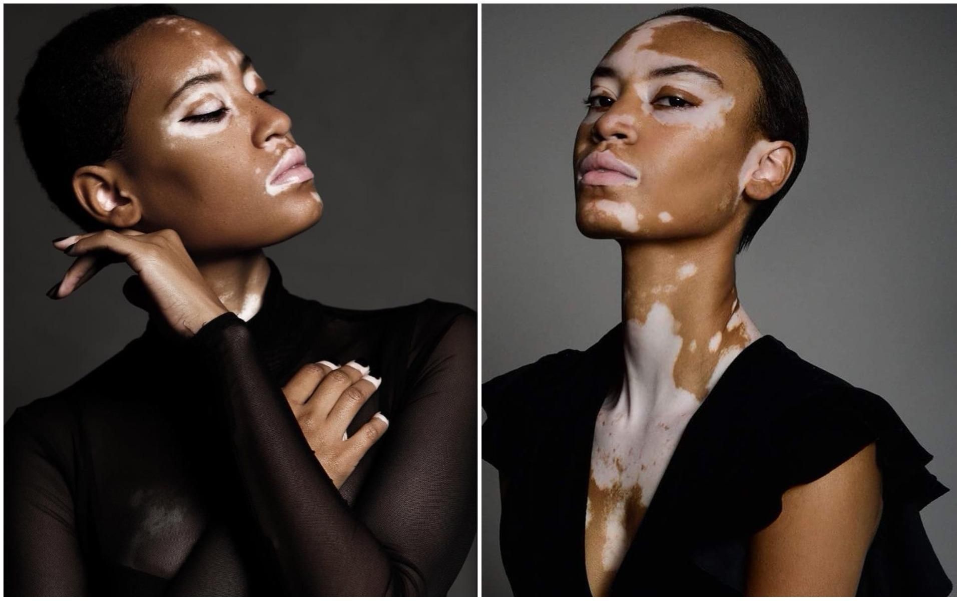 Модель с редким заболеванием кожи стала лицом beauty-бренда: видео
