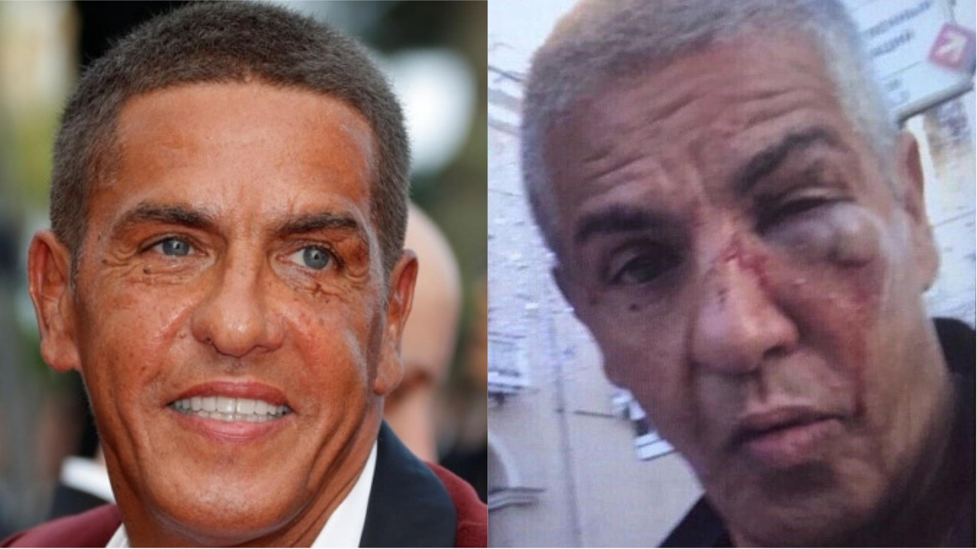 Драка с участием звезды "Такси" Сами Насери: актер в критическом состоянии может ослепнуть