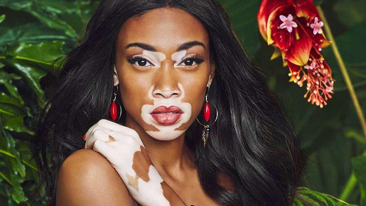 Винни Харлоу – 25: как модель с болезнью витилиго достигла невероятного успеха