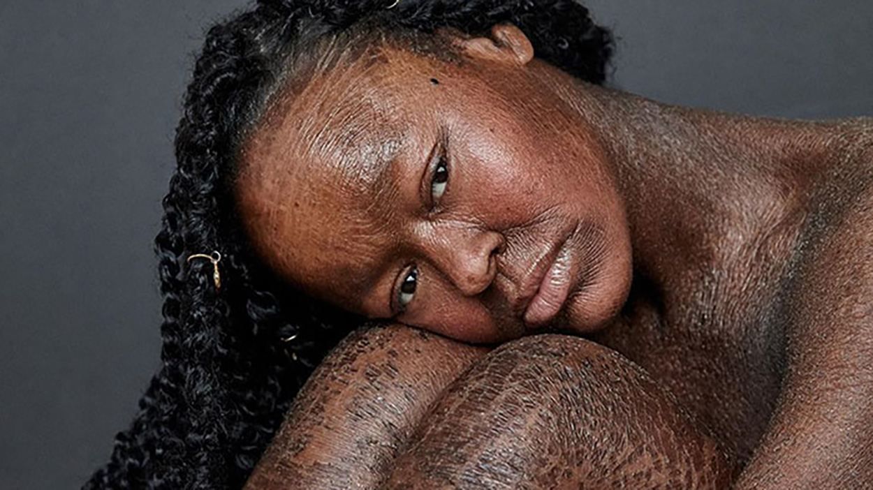 Модель с редким заболеванием кожи поразила сеть: эффектные фото Модель с редким заболеванием кожи поразила сеть: эффектные фото