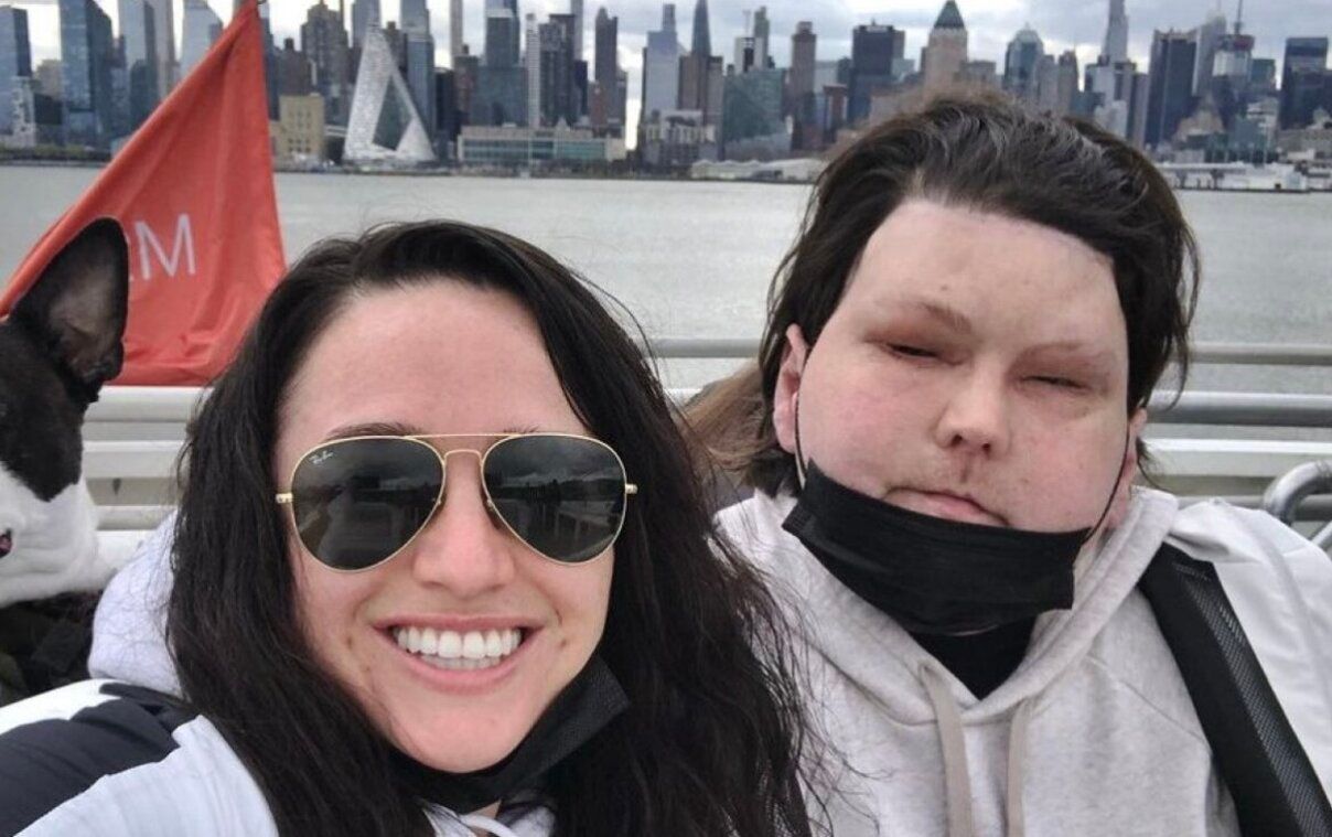 Джо ДіМео, якому пересадили шкіру обличчя, знайшов своє кохання - фото Джо ДіМео, якому пересадили шкіру обличчя, знайшов своє кохання - фото